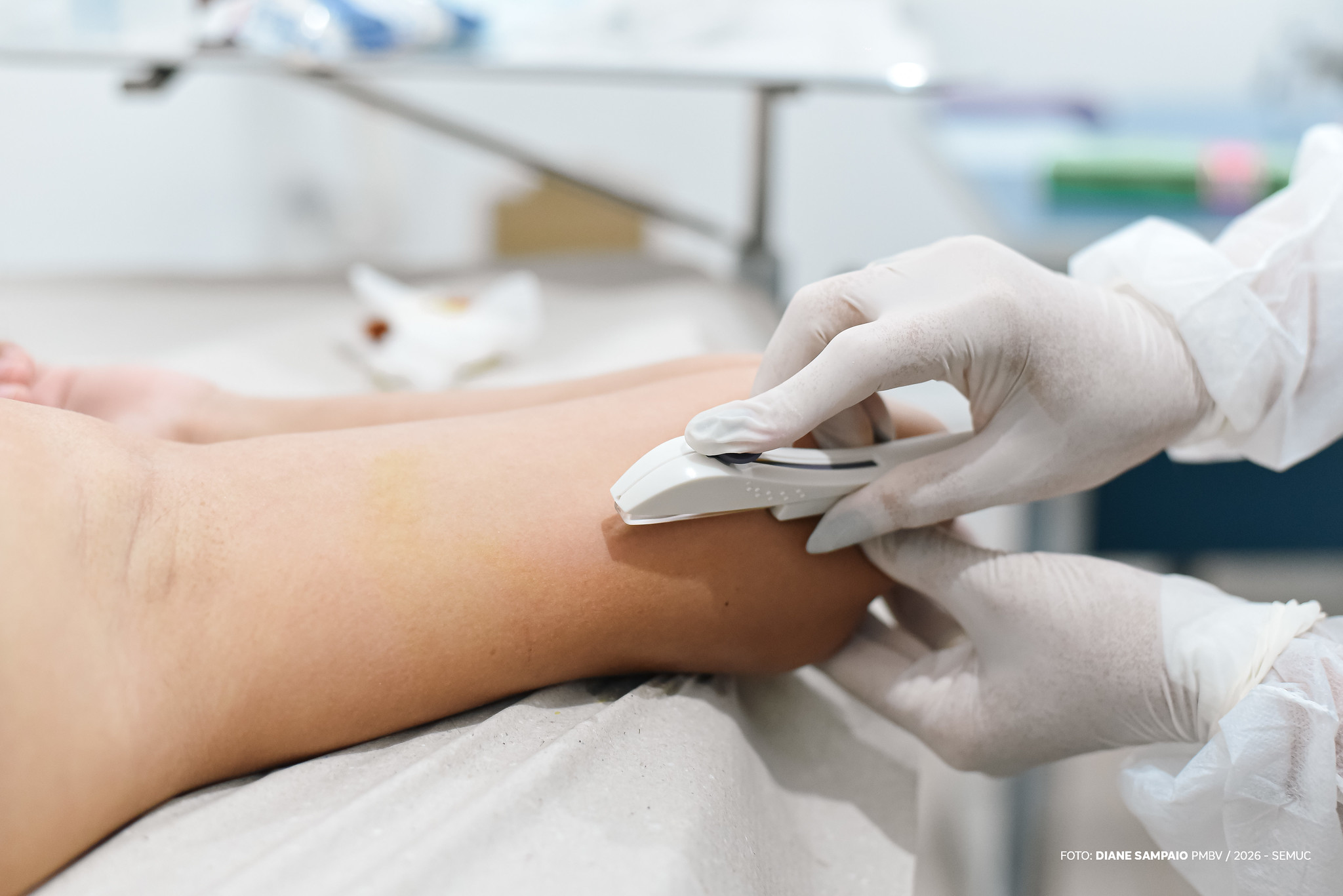 1769004474 575 Prefeitura amplia oferta do implante Implanon na atencao primaria