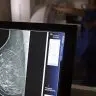 AGU processa medico que apontou mamografia como causadora de cancer